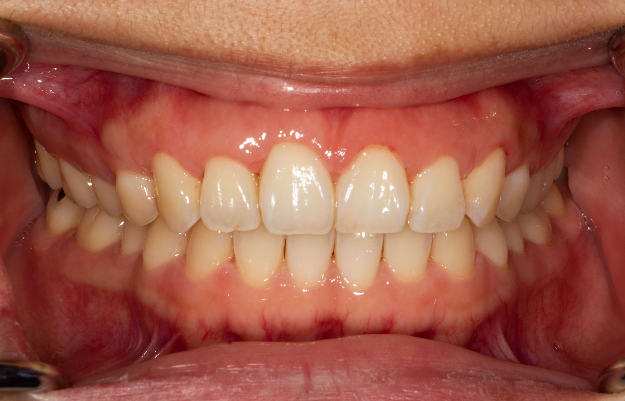  A close-up of a person's teeth and gums, which are healthy and free of disease.