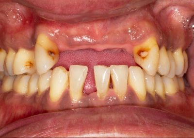 If allowed to progress, periodontitis will lead to tooth loss. Teeth may become so loose that they no longer function, or the repeated development of abscesses, due to excessive bone loss, may prove unrestorable