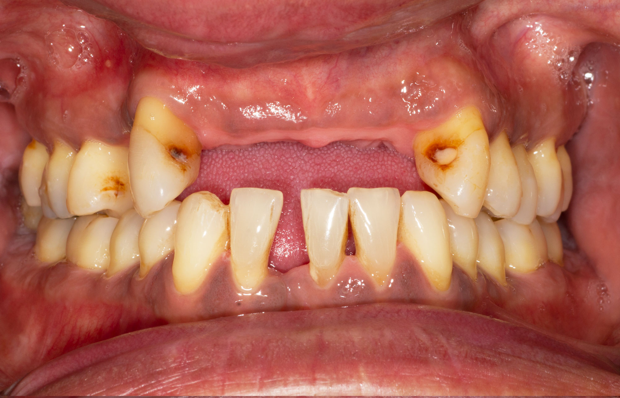 Gum disease symptoms and treatment Cuckfield Dental